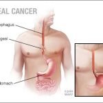 a medical illustration of esophageal cancer